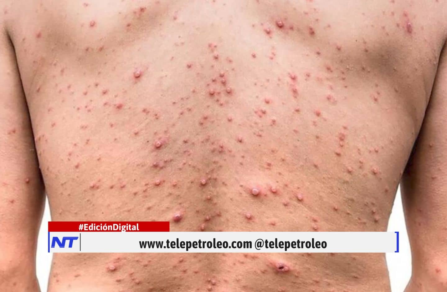 Viruela del mono en Colombia, viruela símica en Colombia, casos de viruela del mono, prevención viruela del mono, síntomas viruela del mono, brote de viruela del mono, viruela del mono en Bogotá, viruela del mono en Antioquia, contagio viruela del mono, medidas contra la viruela del mono.