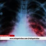 tuberculosis en Santander, casos de tuberculosis en Bucaramanga, tuberculosis en Barrancabermeja, incidencia de tuberculosis en Santander, mortalidad por tuberculosis en Santander, coinfección VIH y tuberculosis en Santander, Secretaría de Salud de Santander tuberculosis, síntomas de tuberculosis en Santander, tratamiento de tuberculosis en Santander, prevención de tuberculosis en Santander