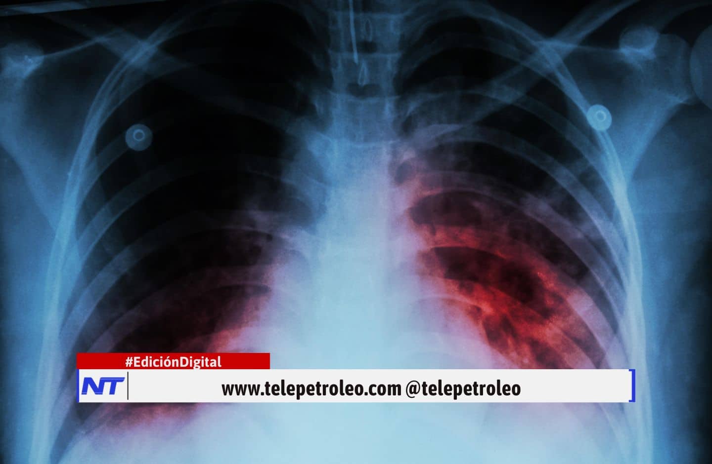 tuberculosis en Santander, casos de tuberculosis en Bucaramanga, tuberculosis en Barrancabermeja, incidencia de tuberculosis en Santander, mortalidad por tuberculosis en Santander, coinfección VIH y tuberculosis en Santander, Secretaría de Salud de Santander tuberculosis, síntomas de tuberculosis en Santander, tratamiento de tuberculosis en Santander, prevención de tuberculosis en Santander