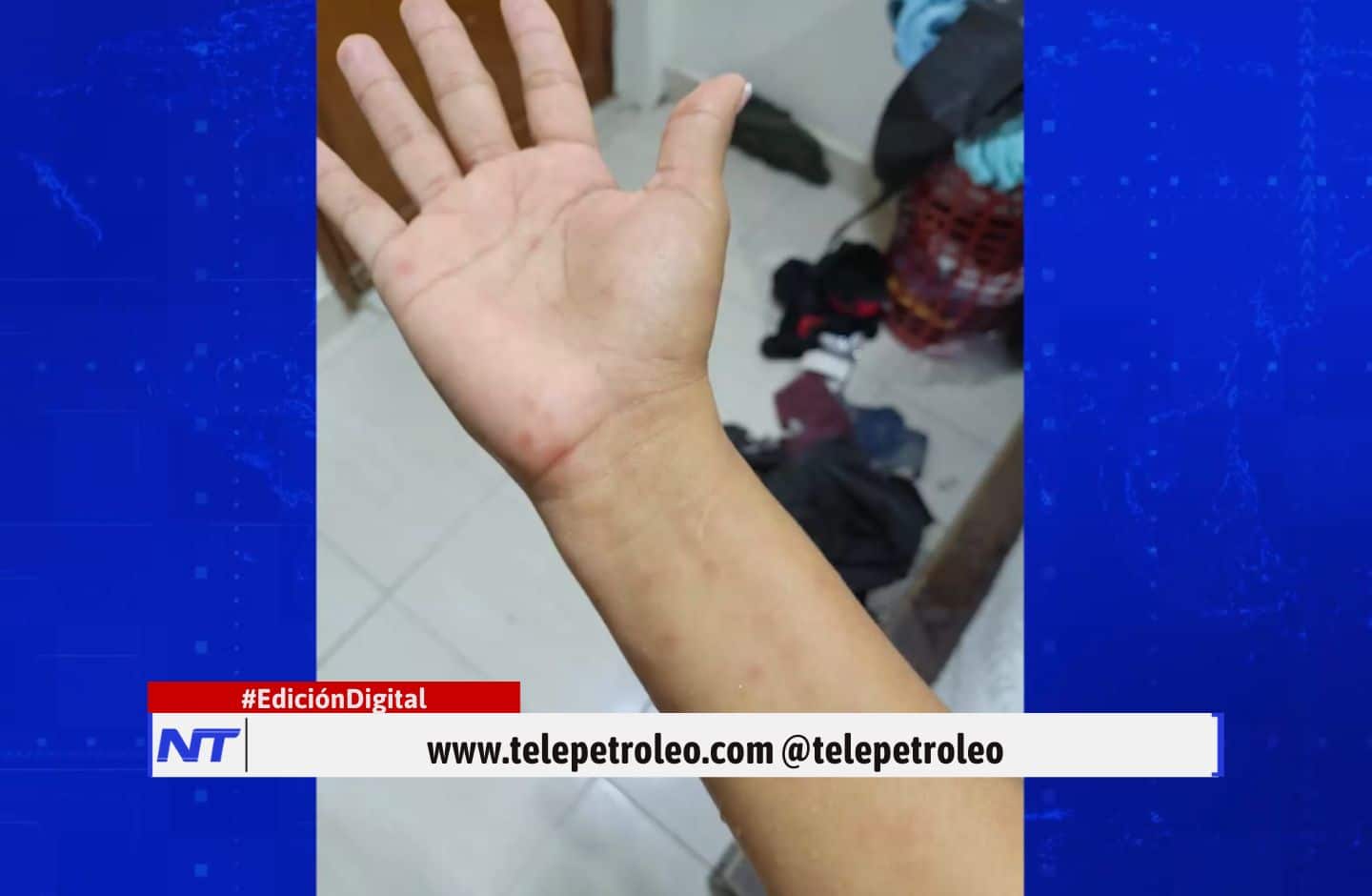 caso sospechoso de viruela símica en Barrancabermeja, viruela símica en Barrancabermeja, autoridades de salud Barrancabermeja, vigilancia epidemiológica Barrancabermeja, Secretaría de Salud de Barrancabermeja, resultado negativo viruela símica, prevención viruela símica Colombia, síntomas de viruela símica, recomendaciones sanitarias Barrancabermeja, salud pública Bucaramanga